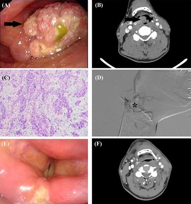 Transcatheter arterial chemoembolization is safe and effective for patients with late-stage or recurrent oral carcinoma